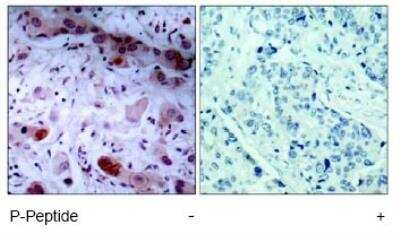 Immunohistochemistry-Paraffin: Jak1 [p Tyr1022] Antibody [NB100-82005] - Analysis of paraffin-embedded human breast carcinoma tissue, using NB100-82005 (left) or the same antibody preincubated with blocking peptide (right).